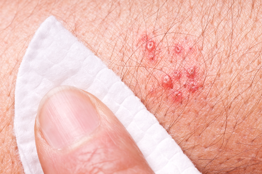 Truth About Shingles 