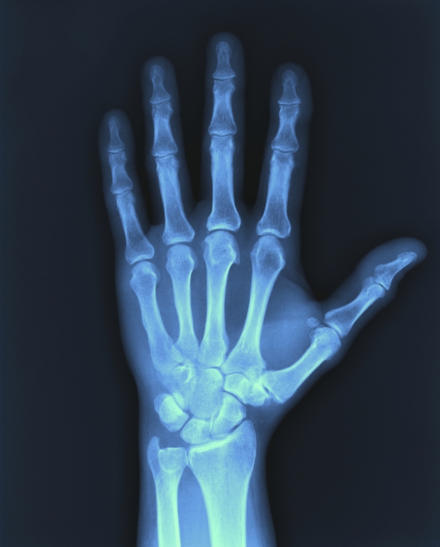 X Ray Of Human Hand With Broken Wrist Fracture Of Radius