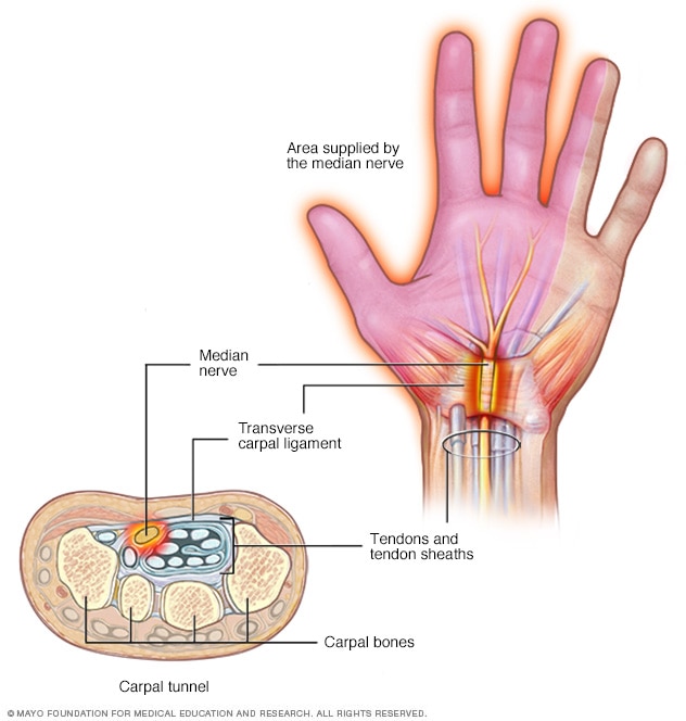 Pinched nerve in wrist 