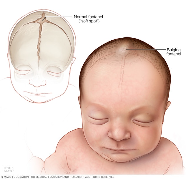 Normal vs. abnormal soft spots (fontanels) of a baby
