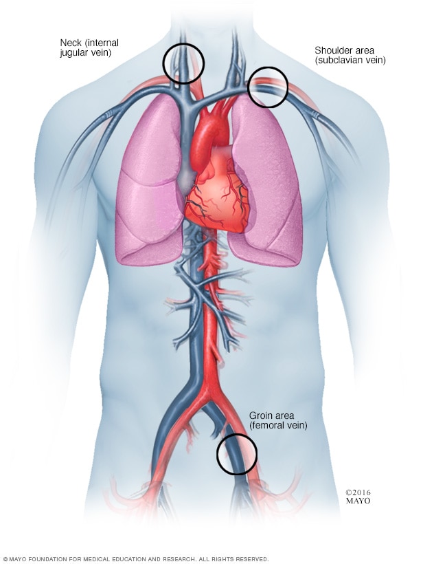 Where catheters are inserted for cardiac ablation.