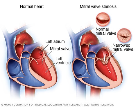 Typical heart and heart with mitral valve stenosis