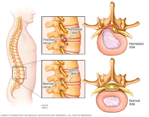 Herniated spinal disk