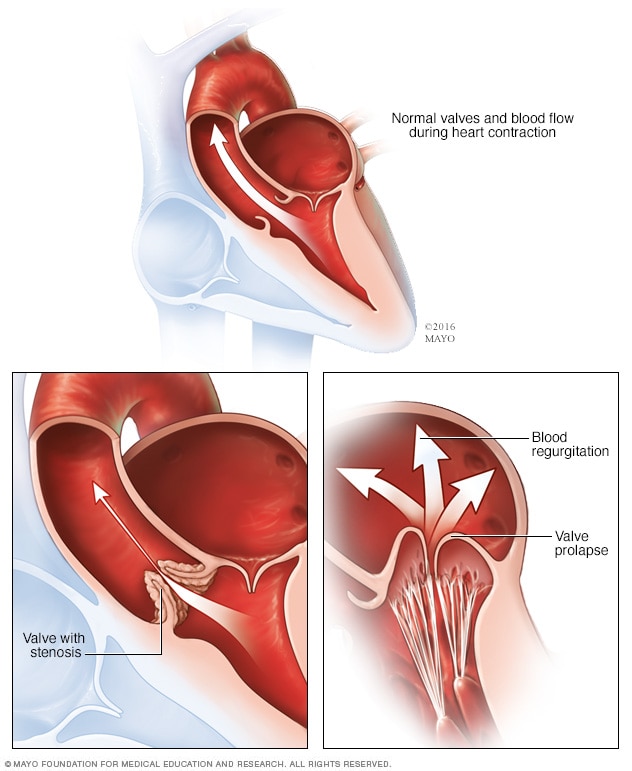 A typical heart and heart valve disease