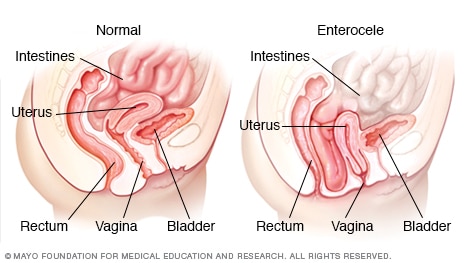 Small bowel prolapse (enterocele)