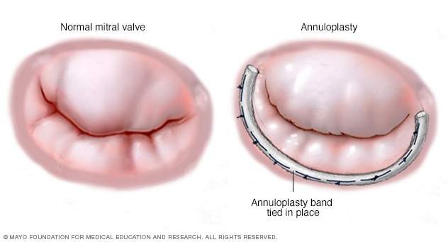 An annuloplasty