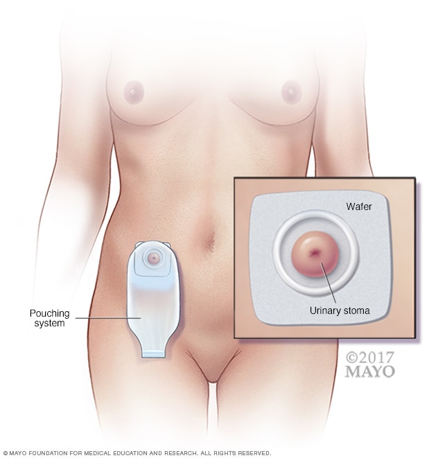 Urostomy stoma and pouching system