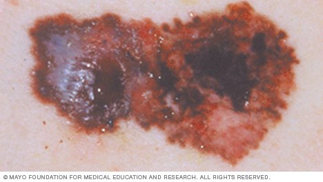 Melanoma showing changes in color