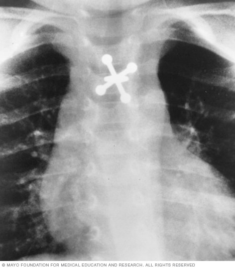 X-ray of swallowed jack