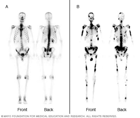Bone scans showing hot spots