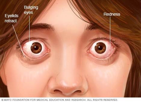 Eye complications associated with Graves