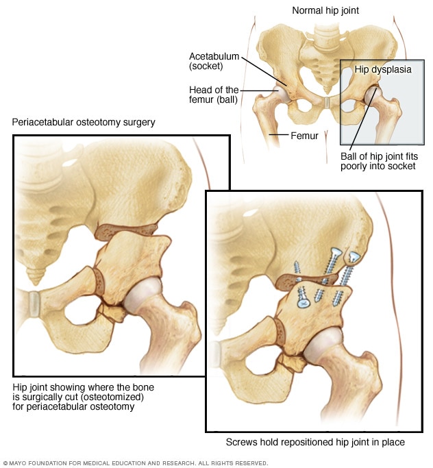 Periacetabular osteotomy
