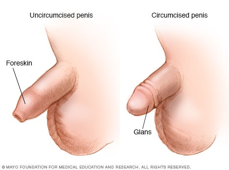 Penis before and after circumcision 
