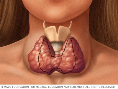 Enlarged thyroid