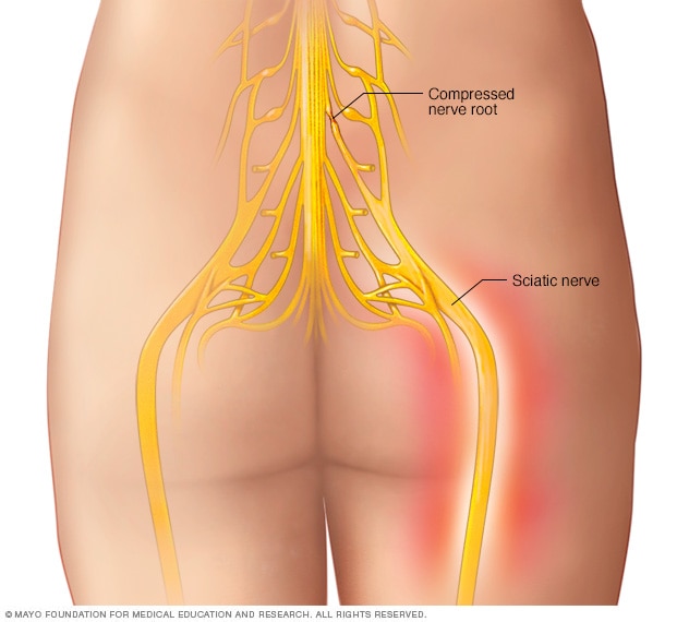 Illustration showing sciatic nerve 
