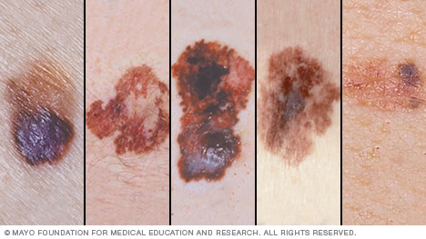 Melanoma skin cancers