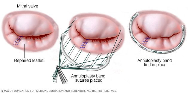 A mitral valve annuloplasty